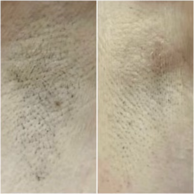 Laser behandeling