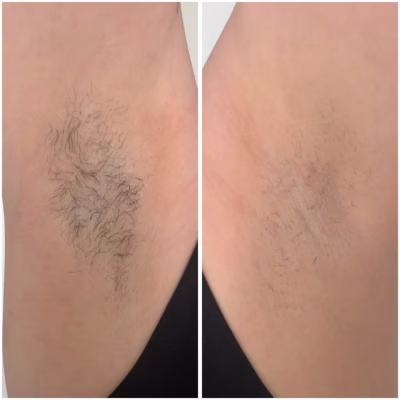 Laser behandeling
